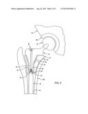 MODULAR FEMORAL STEM COMPONENT FOR A HIP JOINT PROSTHESIS diagram and image