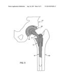 MODULAR FEMORAL STEM COMPONENT FOR A HIP JOINT PROSTHESIS diagram and image