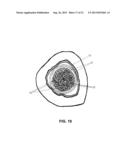 METHOD AND APPARATUS FOR TREATING BONE FRACTURES, AND/OR FOR FORTIFYING     AND/OR AUGMENTING BONE, INCLUDING THE PROVISION AND USE OF COMPOSITE     IMPLANTS diagram and image