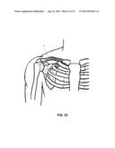 METHOD AND APPARATUS FOR TREATING BONE FRACTURES, AND/OR FOR FORTIFYING     AND/OR AUGMENTING BONE, INCLUDING THE PROVISION AND USE OF COMPOSITE     IMPLANTS diagram and image