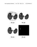 COMPUTER AIDED DIAGNOSTIC SYSTEM INCORPORATING SHAPE ANALYSIS FOR     DIAGNOSING MALIGNANT LUNG NODULES diagram and image