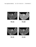 COMPUTER AIDED DIAGNOSTIC SYSTEM INCORPORATING SHAPE ANALYSIS FOR     DIAGNOSING MALIGNANT LUNG NODULES diagram and image