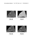 COMPUTER AIDED DIAGNOSTIC SYSTEM INCORPORATING SHAPE ANALYSIS FOR     DIAGNOSING MALIGNANT LUNG NODULES diagram and image