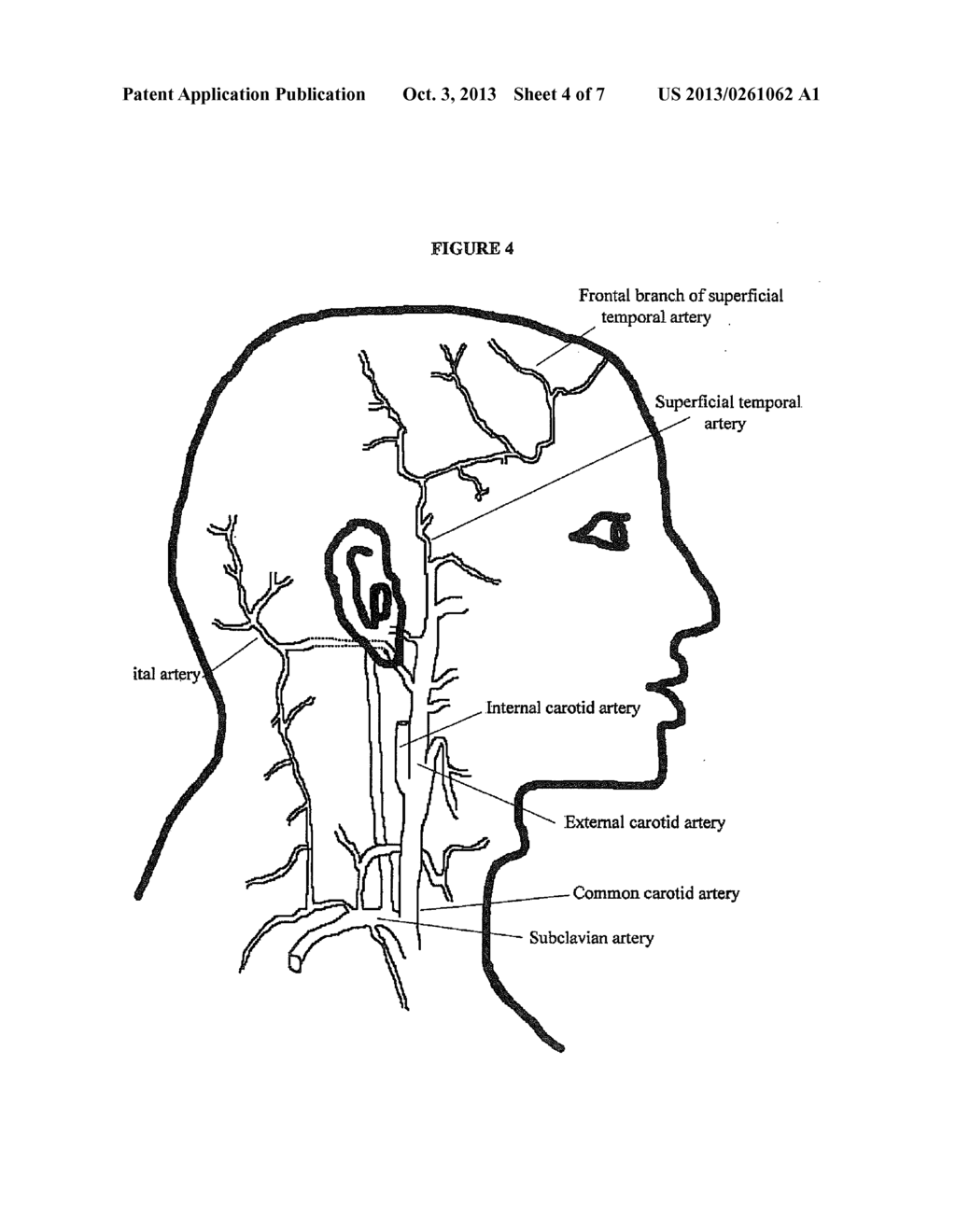 TARGETED DELIVERY OF TARGETED EXOCYTOSIS MODULATORS TO THE SPHENOPALATINE     GANGLION FOR TREATMENT OF HEADACHE DISORDERS - diagram, schematic, and image 05