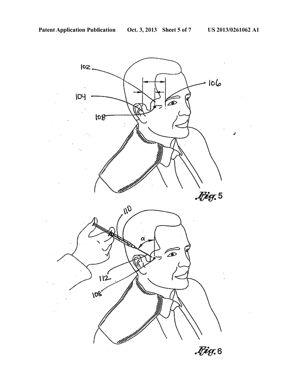 TARGETED DELIVERY OF TARGETED EXOCYTOSIS MODULATORS TO THE SPHENOPALATINE     GANGLION FOR TREATMENT OF HEADACHE DISORDERS - diagram, schematic, and image 06