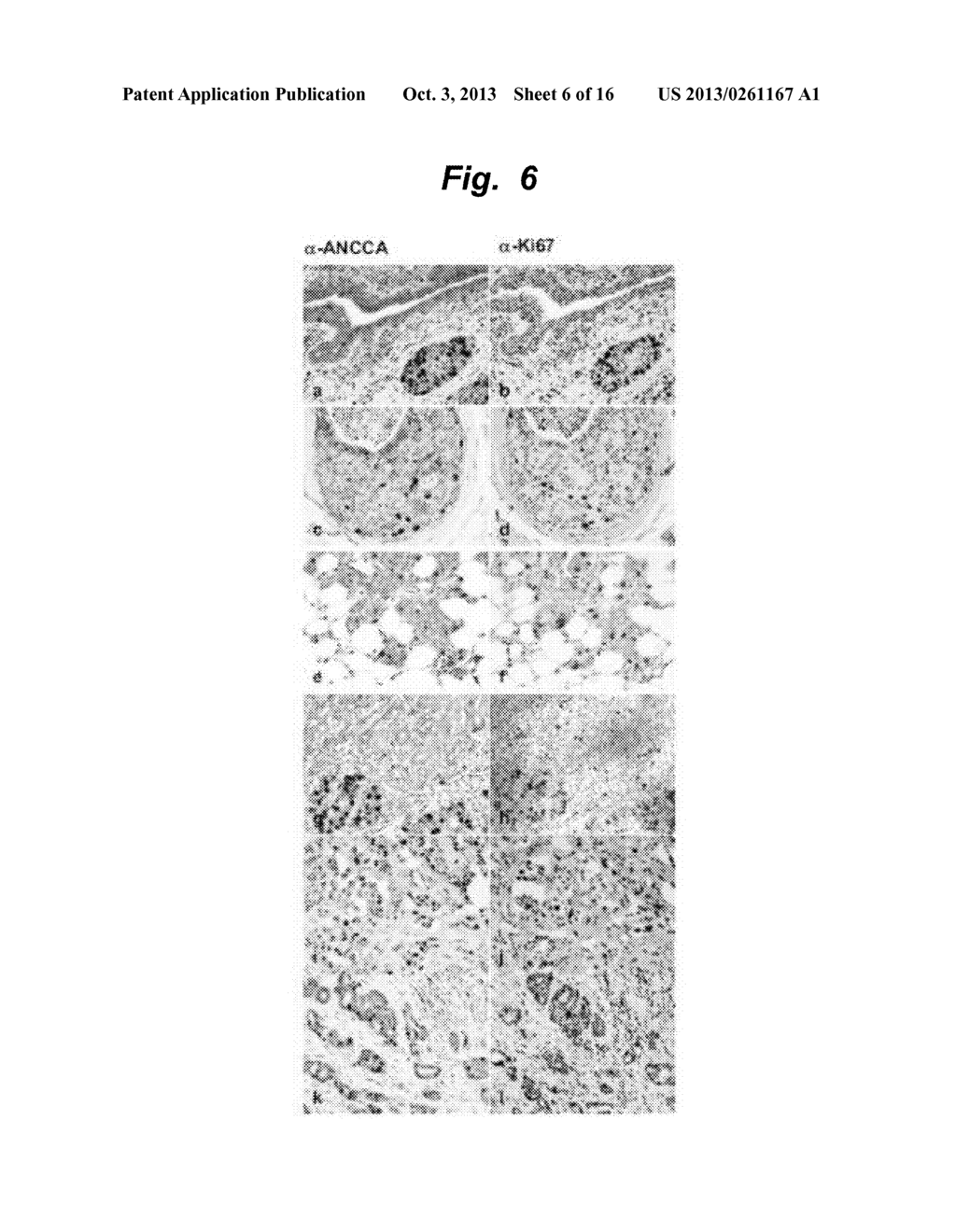 ANCCA as a Diagnostic Biomarker and Therapeutic Target for Breast Cancers - diagram, schematic, and image 07