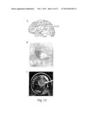 Methods for Prediction and Early Detection of Neurological Events diagram and image