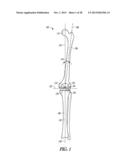 TIBIAL PROSTHESIS SYSTEMS, KITS, AND METHODS diagram and image