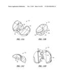 TIBIAL PROSTHESIS SYSTEMS, KITS, AND METHODS diagram and image