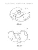 TIBIAL PROSTHESIS SYSTEMS, KITS, AND METHODS diagram and image