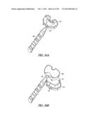 TIBIAL PROSTHESIS SYSTEMS, KITS, AND METHODS diagram and image