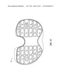 TIBIAL PROSTHESIS SYSTEMS, KITS, AND METHODS diagram and image