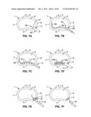 IMPLANTABLE THERMAL TREATMENT METHOD AND APPARATUS diagram and image