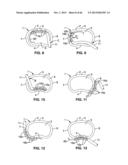 IMPLANTABLE THERMAL TREATMENT METHOD AND APPARATUS diagram and image