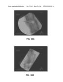 IMPLANTABLE THERMAL TREATMENT METHOD AND APPARATUS diagram and image