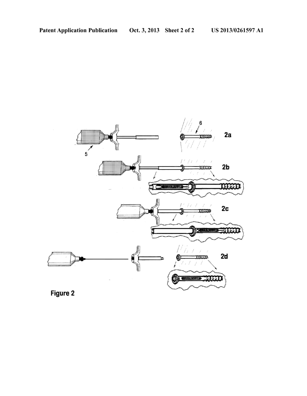 Therapeutic Material Delivery System for Tissue Voids and Cannulated     Implants - diagram, schematic, and image 03