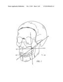 MAXILLARY IMPLANT FOR ADVANCEMENT, EXPANSION AND STABILIZATION OF     REPOSITIONED BONE SECTIONS diagram and image