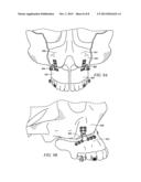 MAXILLARY IMPLANT FOR ADVANCEMENT, EXPANSION AND STABILIZATION OF     REPOSITIONED BONE SECTIONS diagram and image