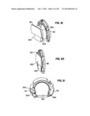 Apparatus and Method for Sternotomy Closure diagram and image