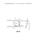 Flexible Endoscopic Stitching Devices diagram and image