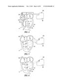 METHODS, DEVICES AND SYSTEMS FOR CARDIAC RHYTHM MANAGEMENT USING AN     ELECTRODE ARRANGEMENT diagram and image