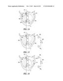 METHODS, DEVICES AND SYSTEMS FOR CARDIAC RHYTHM MANAGEMENT USING AN     ELECTRODE ARRANGEMENT diagram and image