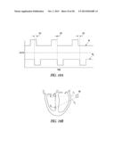 METHODS, DEVICES AND SYSTEMS FOR CARDIAC RHYTHM MANAGEMENT USING AN     ELECTRODE ARRANGEMENT diagram and image