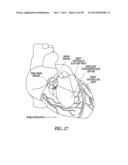 METHODS, DEVICES AND SYSTEMS FOR CARDIAC RHYTHM MANAGEMENT USING AN     ELECTRODE ARRANGEMENT diagram and image