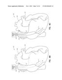 SYSTEM AND METHOD FOR NEURAL STIMULATION diagram and image