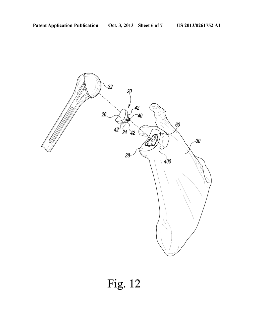 GLENOID DEFECT-FILLING COMPONENT - diagram, schematic, and image 07