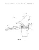 TIBIAL PROSTHESIS SYSTEMS, KITS, AND METHODS diagram and image