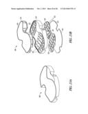 TIBIAL PROSTHESIS SYSTEMS, KITS, AND METHODS diagram and image