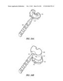 TIBIAL PROSTHESIS SYSTEMS, KITS, AND METHODS diagram and image