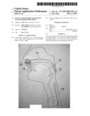 DEVICES AND METHODS FOR TREATING SLEEP DISORDERED BREATHING diagram and image