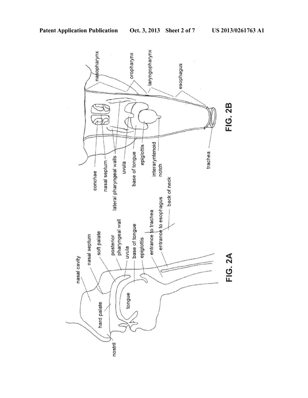 DEVICES AND METHODS FOR TREATING SLEEP DISORDERED BREATHING - diagram, schematic, and image 03