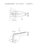 DEVICES AND METHODS FOR TREATING SLEEP DISORDERED BREATHING diagram and image