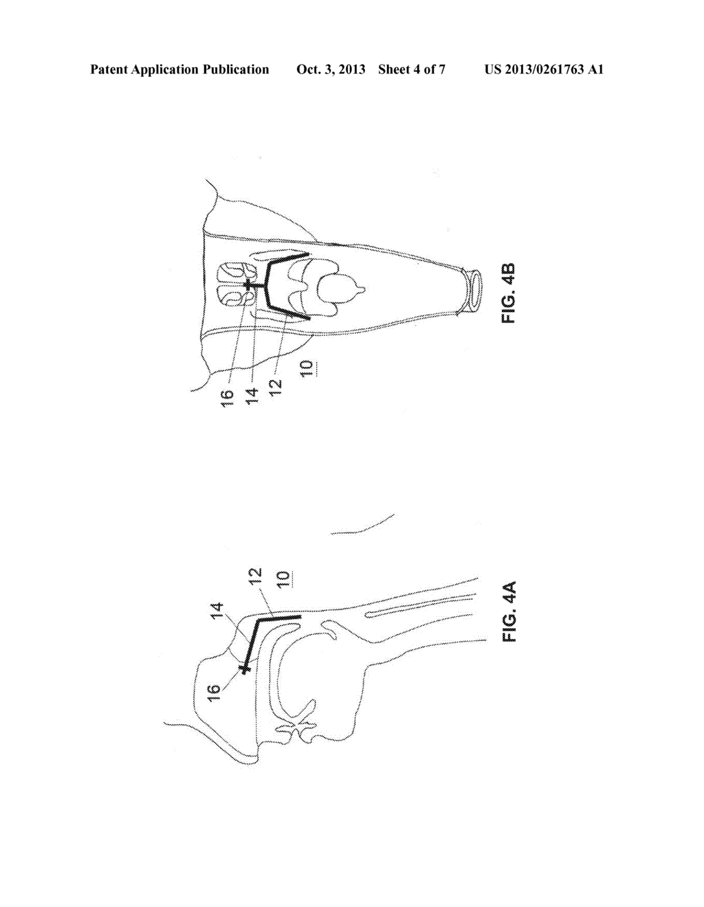 DEVICES AND METHODS FOR TREATING SLEEP DISORDERED BREATHING - diagram, schematic, and image 05