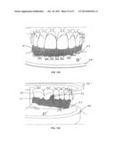TOOTH POSITIONERS, METHOD AND APPARATUS F0R MAKING THE SAME, AND METHOD OF     POSITIONING TEETH USING THE SAME diagram and image