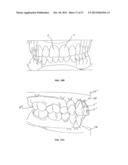 TOOTH POSITIONERS, METHOD AND APPARATUS F0R MAKING THE SAME, AND METHOD OF     POSITIONING TEETH USING THE SAME diagram and image