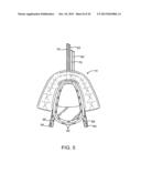 METHODS AND SYSTEMS FOR IMPROVING AIRWAY PATENCY diagram and image