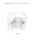 METHODS AND SYSTEMS FOR IMPROVING AIRWAY PATENCY diagram and image