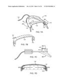 METHODS AND SYSTEMS FOR IMPROVING AIRWAY PATENCY diagram and image