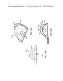 METHODS AND SYSTEMS FOR IMPROVING AIRWAY PATENCY diagram and image