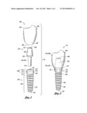 DENTAL IMPLANT diagram and image