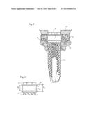 DENTAL IMPLANT, A DENTAL IMPLANT KIT AND A METHOD OF SECURING A DENTAL     BRIDGE TO THE JAW OF A PATIENT diagram and image