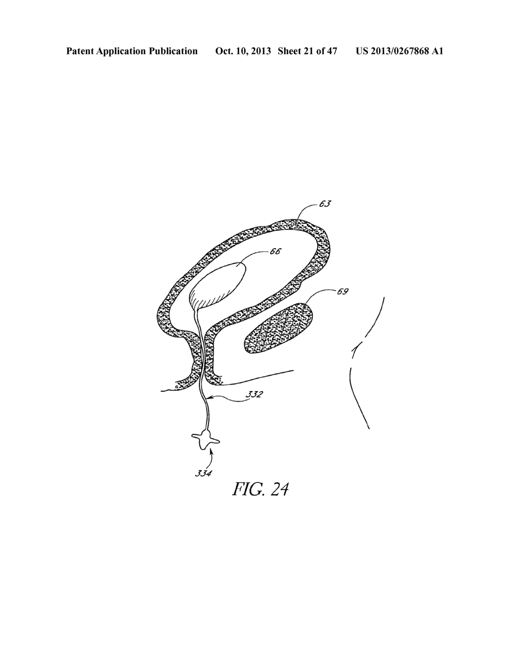 METHOD OF TREATING BENIGN HYPERTROPHY OF THE PROSTATE - diagram, schematic, and image 22