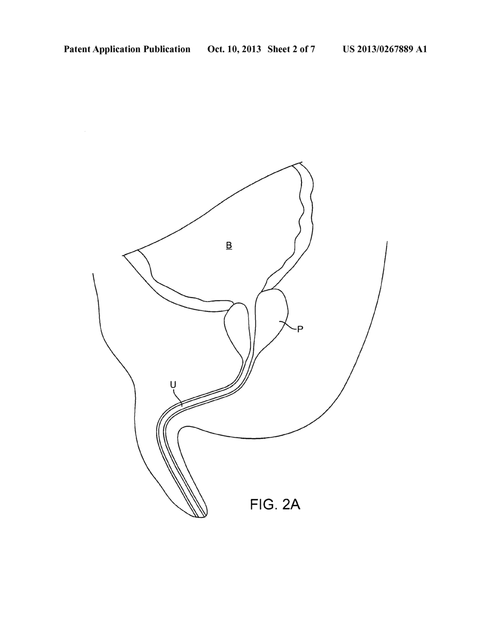 Minimally Invasive Methods and Devices for the Treatment of Prostate     Diseases - diagram, schematic, and image 03