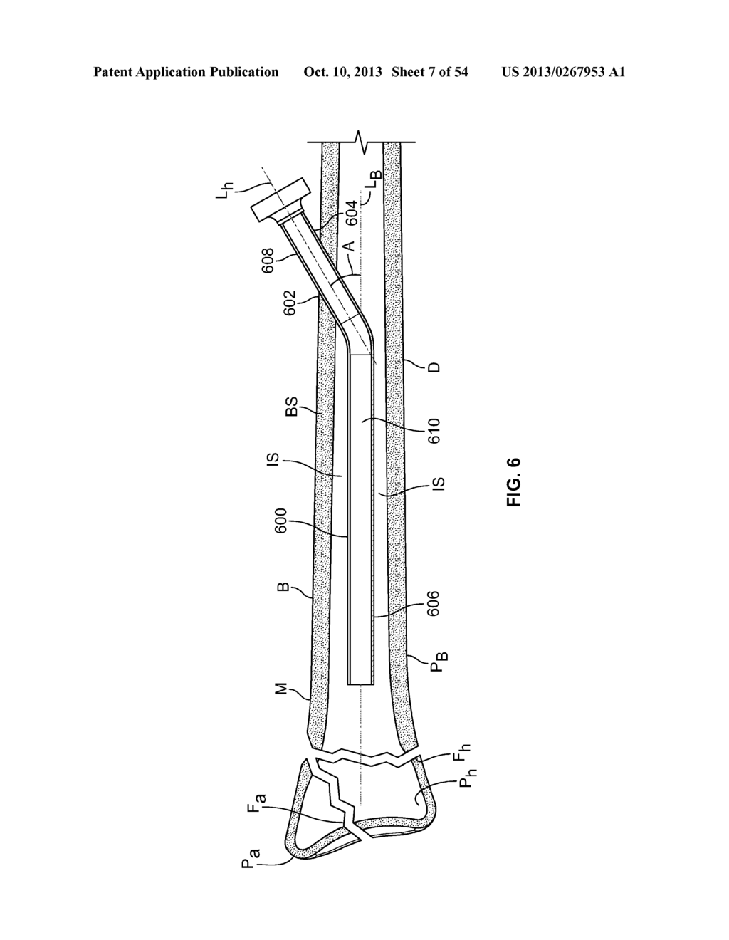 APPARATUS AND METHODS FOR FRACTURE REPAIR - diagram, schematic, and image 08