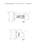 Surgical Treatment System and Method for Performing an Anastomosis Between     Two Hollow Ducts in a Patient, in Particular Between the Bladder and the     Urethra diagram and image