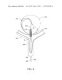 OVER-THE-WIRE EXCLUSION DEVICE AND SYSTEM FOR DELIVERY diagram and image